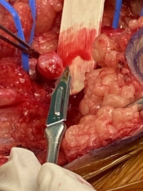 Neuroma Resection